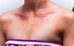 Кремът с висок слънцезащитен фактор невинаги спасява от обриви алергичните