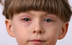 От алергичен конюнктивит страдат около 15% от населението на планетата
